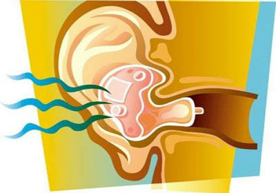 一般早期耳鸣是什么症状呢